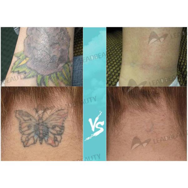 Best High Energy 1500mj 1064nm 532nm Painless Permanent Skin Age Spot Freckle Removal Machine Yag Laser Remove Tattoo