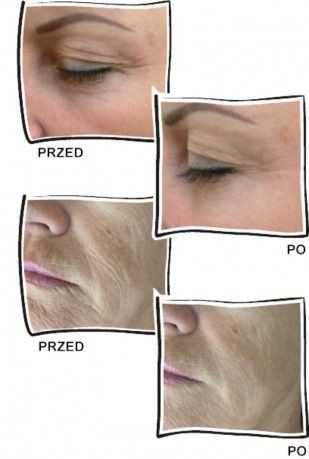 Beauty Equipment Hot Sale Fractional Rf Microneedle Skin Solution Beauty Tighten Machine
