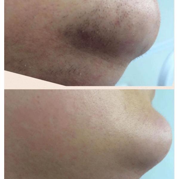 Triple wavelength diode laser machine for hair removal pemanently and painless