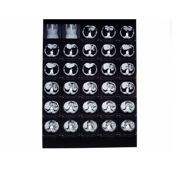 8in x 10in High Density Medical Dry Film For Fuji DRYPIX  3000 / 2000 / 1000 Printer