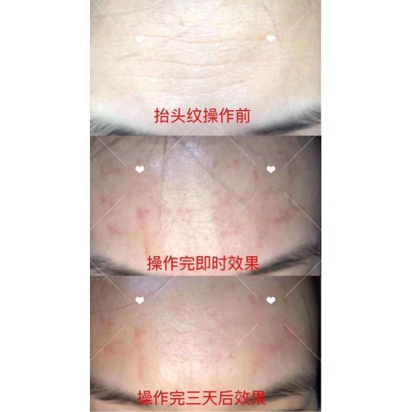 Beauty Equipment Hot Sale Fractional Rf Microneedle Skin Solution Beauty Tighten Machine