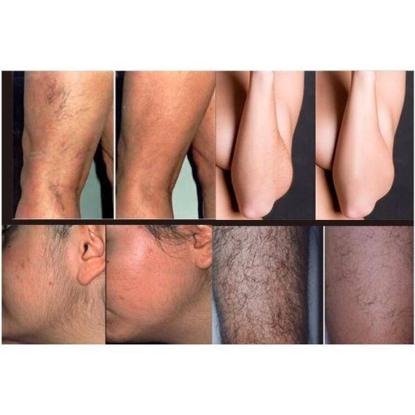 Triple wavelength diode laser machine for hair removal pemanently and painless