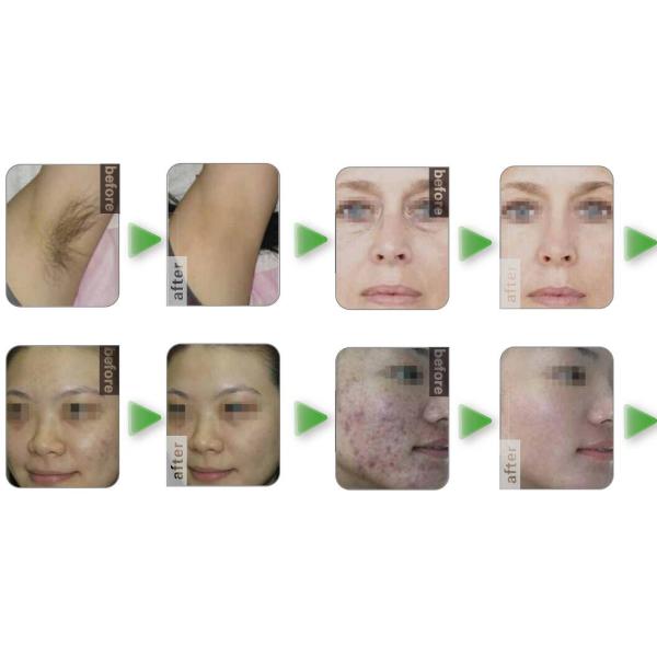 OPT Hair Removal/ skin rejuvenation/ face tightening the SHR ipl elight beauty machine