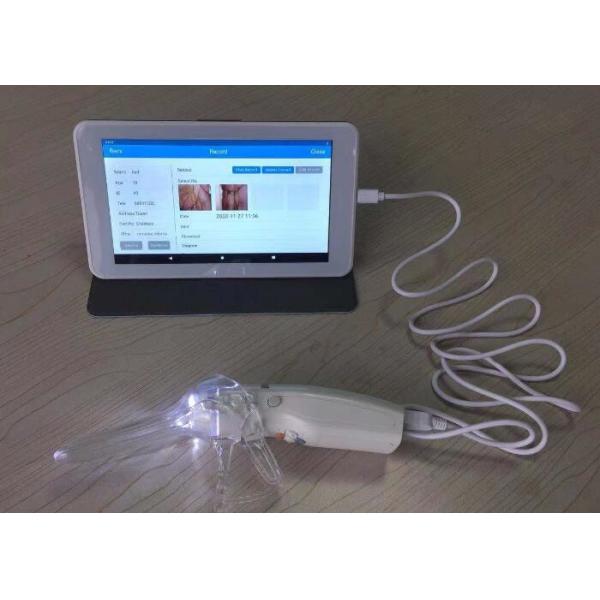 Monitor Treatment and Prevent Recurrence Digital Electronic Colposcope Self - Inspection